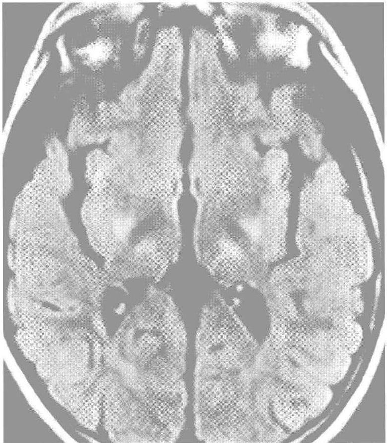 23.足月新生兒缺氧缺血性腦病